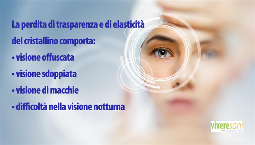 La cataratta: progressiva opacizzazione del cristallino La cataratta: progressiva opacizzazione del cristallino